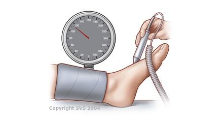 abi blood pressure test