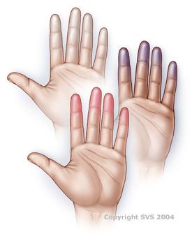 This image is a graphic of three left hands stacked vertically. The top hand's finger tips are white. the middle hand's fingertips are purple, the bottom hand's fingertips are red.