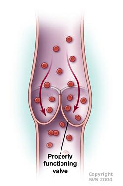 Deep Venous Insufficiency - TeachMeSurgery