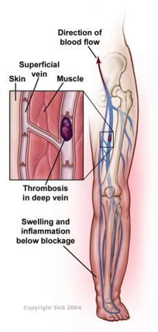 Deep Vein Thrombosis