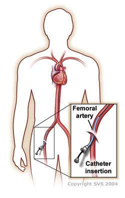 This image is an outline of a body, showing the heart and arteries. A pop-out shows a closeup of a catheter being inserted into the femoral artery in the leg of the body.
