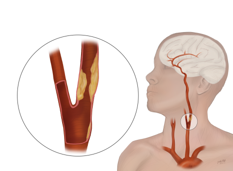 A view of an artery with carotid artery disease