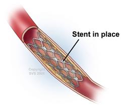 Visual of a stent in a renal artery