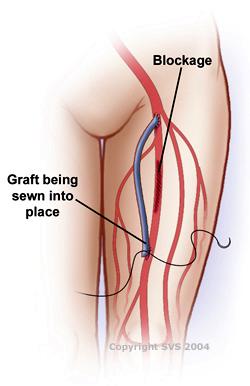 A blockage is displayed. A graft is being sewn into place.