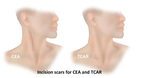 TCAR scars vs CEA scars