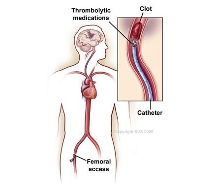 Clot buster — what is CLOT BUSTER definition 