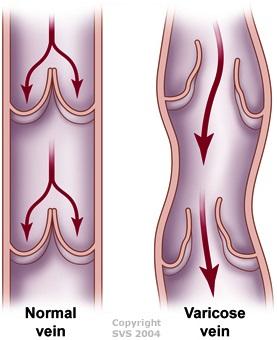 Normal vein versus varicose vein