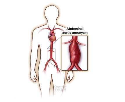 Illustration of abdominal aortic aneurysm in human body