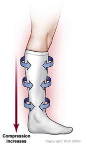 Compression stocking on leg; illustrates where compression takes place on lower leg