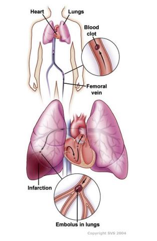 Lungs and veins when impacted by a pulmonary embolism