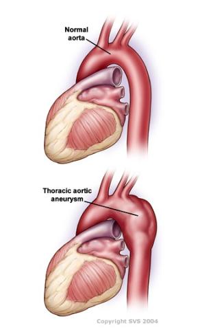 This is a graphic of two hearts. The first heart shows a normal aorta. The second heart shows an aorta with ballooning in it, a caption says "Thoracic Aortic Aneurysm"