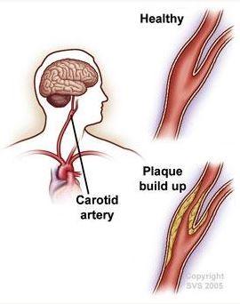 Healthy artery VS plaque built up