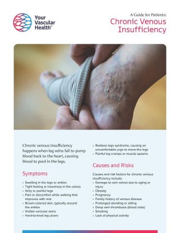 Chronic Venous Insufficiency Image of Flyer