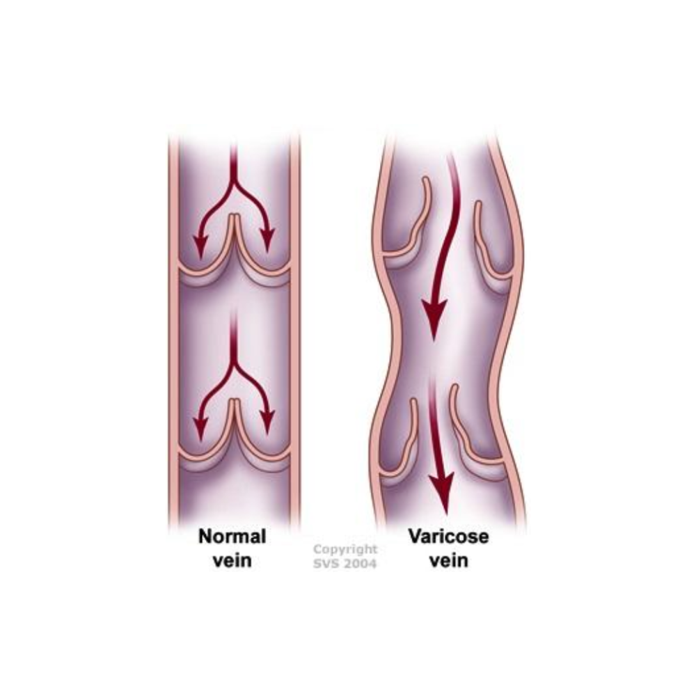 Varicose veins