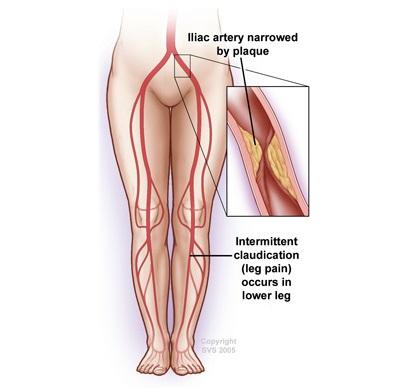 An illiac artery narrowed by plaque is shown in a leg diagram. Intermittent claudication (leg pain) occurs in lower leg and is shown in the diagram.