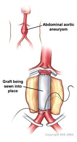 Illustration showing an abdominal aortic aneurysm with a secondary illustration showing a graft being sewn into place