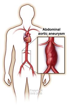 abdominal aortic aneurysm closeup on body