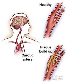 Carotid artery illustrations with healthy and unhealthy arteries