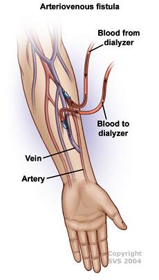 fistula for dialysis placement