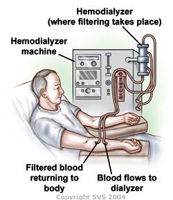 A hemodialyzer machine is showing where filtering takes place. Blood flows to dialyzer through the machine. A patient is shown with filtered blood returning to the body.