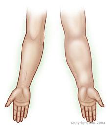 Regular arm VS an arm with lymphedema