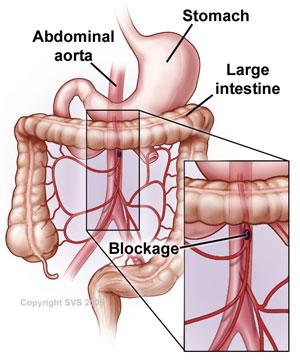 A detailed layout of the large intestine with the abdominal aorta and stomach. The image zooms in on a blockage in the abdominal aorta.