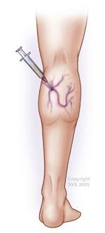 Sclerotherapy -- chemical injected into vein