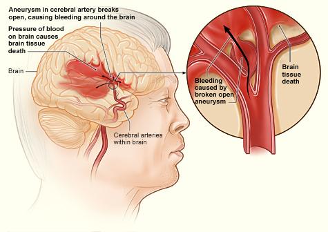 A graphic diagram of a white, elderly man having a stroke. The image shows the brain, a bleed, and cerebral arteries. Text points to the arteries, "Aneurysm in cerebral artery breaks open, causing bleeding around the brain." Below that, "Pressure of blood on brain causes brain tissue death" An additional graphic shows a closeup of the cerebral artery, with text pointing to "Brain Tissue death" and "Bleeding caused by broken open aneurysm"