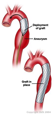 This image is a graphic of two aortas. The first aorta shows the deployment of a graft in the section of the aorta with the aneurysm. The second image shows the graft in place.