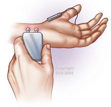 This image shows a venogram being performed on a wrist.
