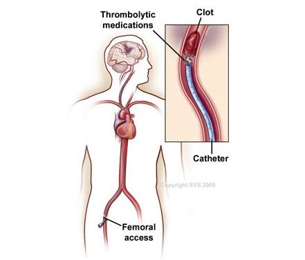 Illustration of treating deep vein thrombosis, with medication and via catheter
