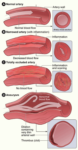 A normal artery shows normal blood flow. A narrowed artery with inflammation shows decreased blood flow. A totally occluded artery with inflammation and scaring shows no blood flow. An aneurysm shows abnormal blood flow and dilation containing very thin arterial wall. A thrombus clot is shown at the bottom right. 