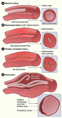 A normal artery shows normal blood flow. A narrowed artery with inflammation shows decreased blood flow. A totally occluded artery with inflammation and scaring shows no blood flow. An aneurysm shows abnormal blood flow and dilation containing very thin arterial wall. A thrombus clot is shown at the bottom right.