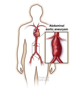 Drawing of patient with highlighted section showing abdominal aortic aneurysm