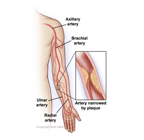 This image is a graphic of a left arm. The arm shows the arteries, in order from shoulder to wrist, 'Axillary artery,' 'Brachial artery,' 'Ulnar artery', 'Radial Artery'. The image shows a pop-out closeup of the artery narrowed by plaque.