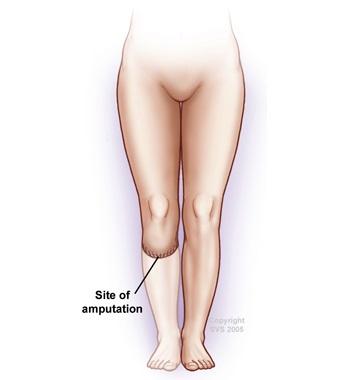 Illustration showing site of amputation on right leg, below knee