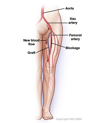 An aorta, iliac artery, femoral artery and blockage are shown. New blood flows down through the graft.