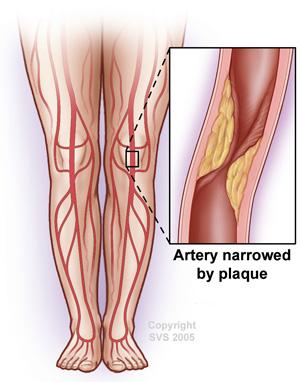 Legs with a highlighted view of the artery narrowed by plaque