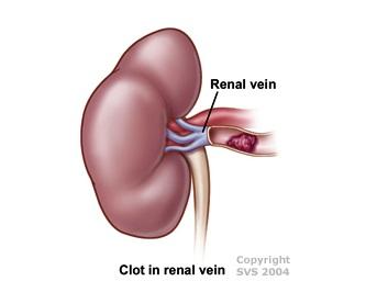 Clot in a renal vein