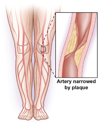 illustration of a leg with claudication, including a close-up shot